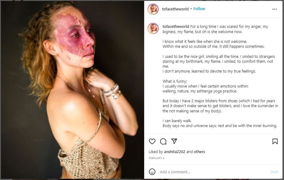 Potret Wanita Punya Tanda Lahir Besar di Wajah, Tetap Pede (instagram.com/tofacetheworld)